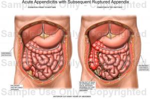 Penyakit-Usus-Buntu-Appendicitis
